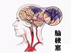 養(yǎng)成好的生活習(xí)慣，能夠有效預(yù)防腦梗塞